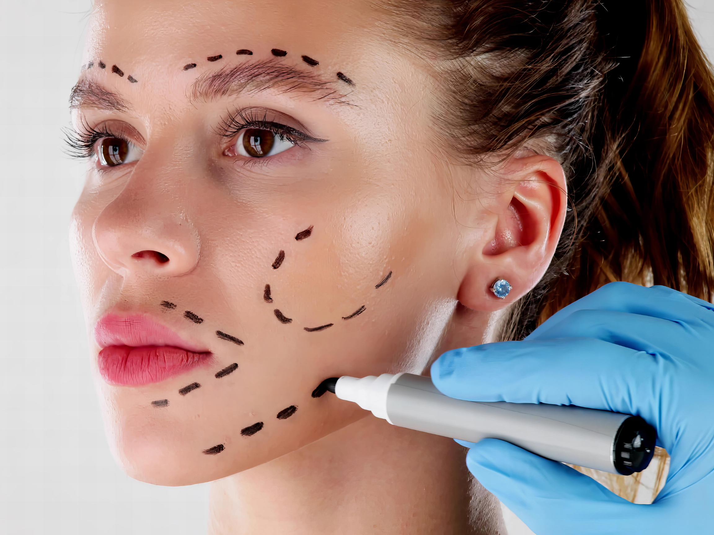 Facelift surgical planning — medical travel abroad